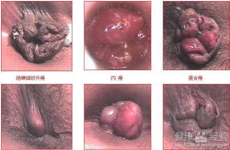 偏方治痔瘡，一種古老而有效的自然療法，古老偏方治療痔瘡的自然療法，有效且傳承至今
