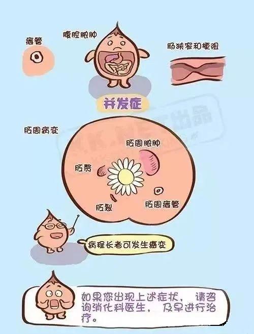 克羅恩病最常見的癥狀及其影響，克羅恩病常見癥狀及其影響概述